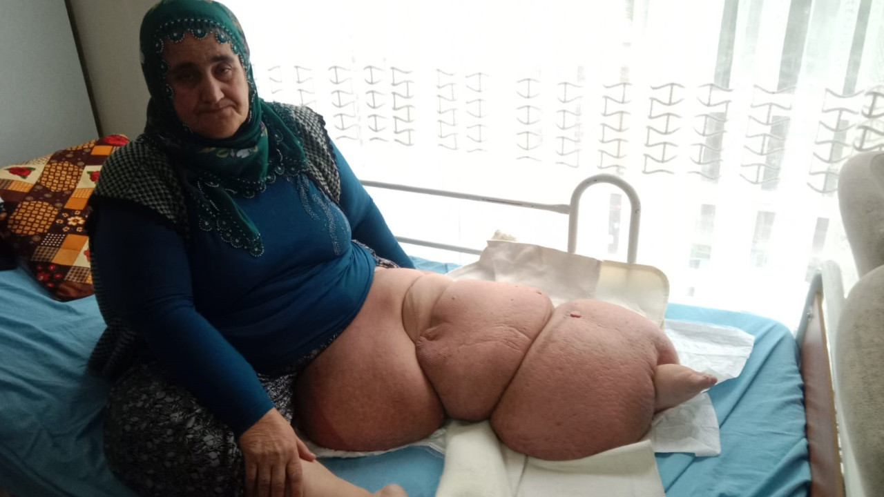 Fil hastalığı bacağını 100 kilo yaptı