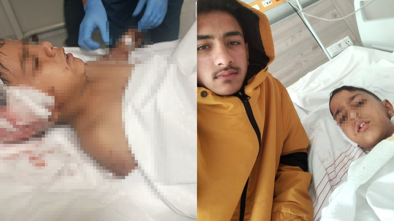 Ankara’da sokak köpeğinin saldırısına uğrayan çocuk yaralandı