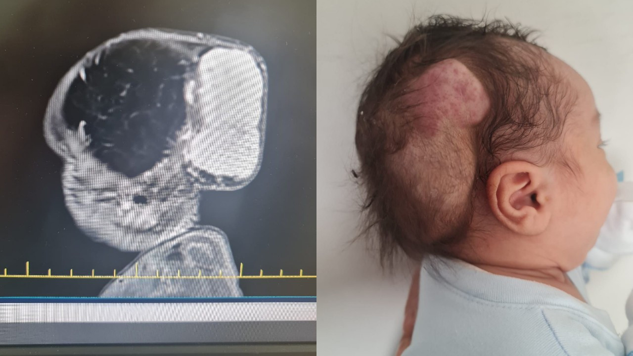 Talha bebeğin dünyada nadir görülen beyin tümörü, 4 saatlik operasyonla alındı