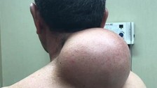 Boynundaki kocaman şişlikten çıkanlar mide bulandırdı! 'Doktor Çıban' bile gözlerine inanamadı