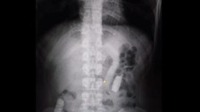 Midesinde taşıdığı 1 kilo uyuşturucuyla yakalandı