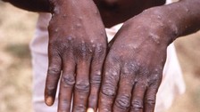 Afrika'da maymun çiçeği salgınına karşı aşılamalara başlanacak