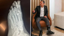 Özgür Özel'den 'Vuruldu' iddilarına sert tepki! Ayağındaki kırıkların filmlerini paylaştı