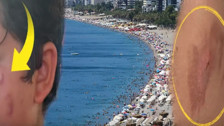 Antalya'da tedirgin eden olay! Denize girenler vücudunda yanıklarla çıkıyor