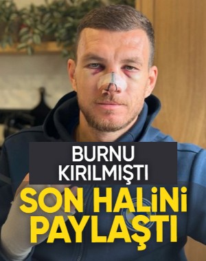 Fenerbahçe'nin kaptanı Edin Dzeko burnunun kırılmasının ardından son halini paylaştı