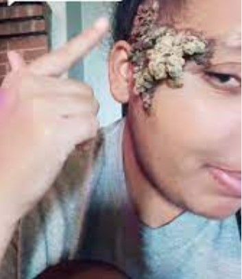 Doğum lekesi sandı, gerçek bambaşka çıktı! Yüzünün tamamını kaplayınca soluğu doktorda aldı! - Resim: 3