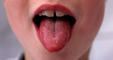Strep A bakteriyel enfeksiyonu Türkiye'de