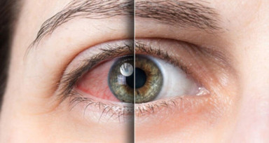 Bahar aylarında göz alerjilerine dikkat edilmeli