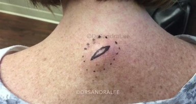 Boynunda sivilce zannettiği şişlikten bakın ne çıktı! Giderek büyüyünce doktor bile şaştı kaldı