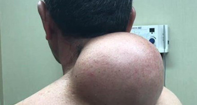 Boynundaki kocaman şişlikten çıkanlar mide bulandırdı! 'Doktor Çıban' bile gözlerine inanamadı