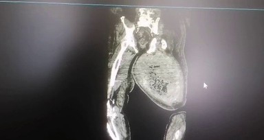 Ayak ağrısı için hastaneye gitti! Doktorlar gözlerine inanamadı! Ameliyat sonrası tam 8.9 kilo zayıfladı