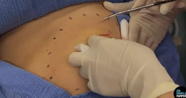 Portakal büyüklüğündeki şişlikten bakın ne çıktı! Midesi bulanan izlemesin