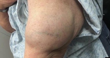 Kolundaki şişlikten bakın ne çıktı! Giderek şişmeye başlayınca dayanamayıp doktorun yolunu tuttu