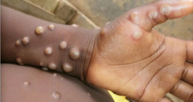 Maymun çiçeği virüsü dünyayı alarma geçirdi! Monkeypox nasıl bulaşır, belirtileri neler?