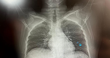 İmplant vidası ciğerine kaçan hasta ölümden döndü