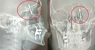 Beynine saplanan implant hayatını kararttı: 2 yıldır adalet bekliyor