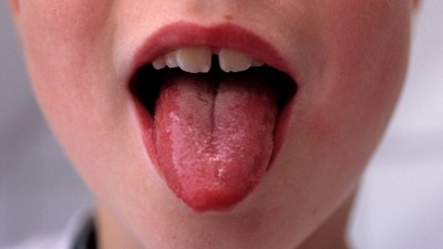 Strep A bakteriyel enfeksiyonu Türkiye'de