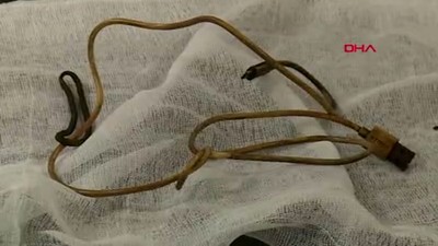 15 yaşındaki çocuğun midesinden 1 metrelik şarj kablosu ve toka çıktı