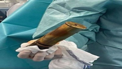 Fransa'da bir tuhaf olay! 88 yaşındaki adamın anüsüne top mermisi sıkışınca hastaneyi komple boşalttılar