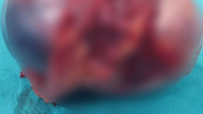 14 yaşındaki kızın böbreğinden 9 santim kitle çıktı