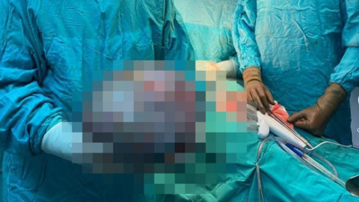 Kadın hastanın karnından tam 8 kiloluk kitle çıktı: Doktorlar dahi şaşkına döndü