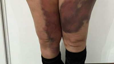 Belçika'dan gelen genç kadın Türkiye'de yağ aldırma operasyonu yaptırdı! Geçirdiği operasyon sonrası psikolojisi bozulan kadın hastaneye dava açtı...