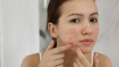 Uzmanlardan sivilce ve aknelere karşı arı zehri ve propolis önerisi