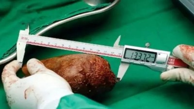 62 yaşındaki adamdan çıkarılan böbrek taşı iki ayrı kategoride Guinness Rekorlar Kitabı'na girdi! Dünyanın en geniş çaplı ve en ağırı