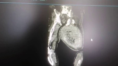 Ayak ağrısı için hastaneye gitti! Doktorlar gözlerine inanamadı! Ameliyat sonrası tam 8.9 kilo zayıfladı