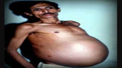 Hindistan'da tüm dünyayı şoke eden "hamile adam" vakası