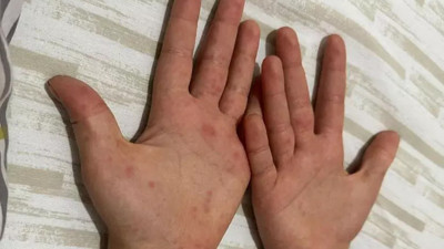 Sağlık Bakanlığı'ndan 81 ile 'kızamık' yazısı! 'Önlemleri artırın'