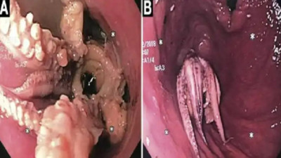 Kusma şikayeti ile hastaneye giden adamın boğazından ahtapot çıktı!