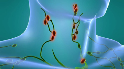 Lenf kanseri nedir? Lenf kanseri nedenleri, belirtileri, tedavisi