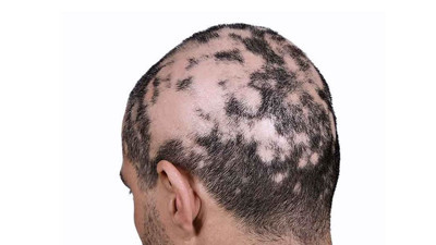 Saçkıran nedir, neden olur? Saçkıranın belirtileri, tedavisi ve evde doğal çözümler