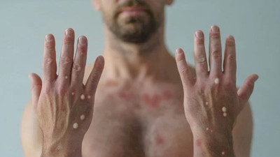 DSÖ'den maymun çiçeği uyarısı: Dünya genelinde 90 binden fazla vaka görüldü