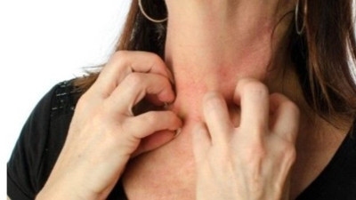 Uyuz hastalığından kurtulmak mümkün mü? Uzmanından kritik açıklama