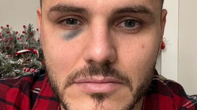 Fenerbahçe derbisinde direğe çarpan Icardi'nin elmacık kemiği kırıldı