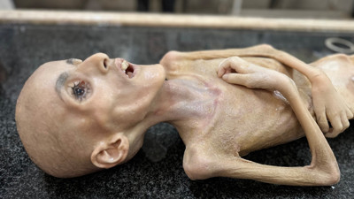 Gazze'de boğazları düğümleyen olay! 10 yaşındaki çocuk bir deri bir kemik halde açlıktan öldü