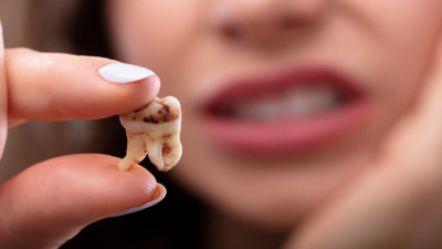 Rüyada Çürük Diş Görmek Ne Anlama Gelir? Neye Delalet Eder?