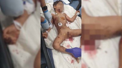 Sokak köpeklerinin saldırısına uğrayan çocuk ağır yaralandı