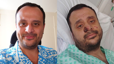 DSÖ'nün 'Farkındalık yüzü' Harun Tulunay: Mpox ızdırabım oldu ama o zamandan bu zamana çok etkili aşılar geliştirildi