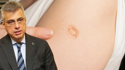 Vücudunda çiçek aşısı izi olanlar maymun çiçeği virüsüne karşı yüzde 85 koruma altında