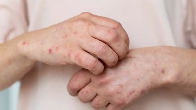 Avrupa'da maymun çiçeği virüsü uyarısı: Risk düşük, ancak hazırlıklı olmak önemli
