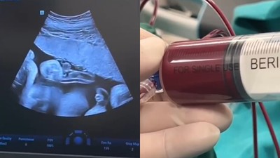 Anne karnındaki 8 aylık bebeğe kan nakli yapıldı
