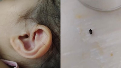 İzmit’te parkta 3 yaşındaki çocuğun kulağına kene yapıştı