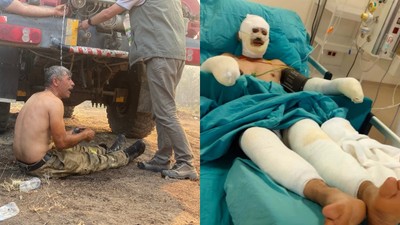 "Yanıyorum" diye feryat eden orman işçisi Kader Dereli’nin tedavisi sürüyor
