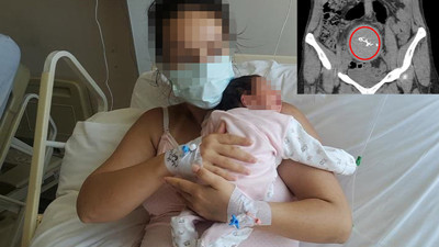 2 yıl sonra ortaya çıktı: Doğumda unutulan cisme soruşturma