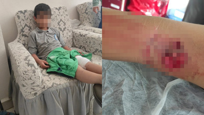 Okula giderken sokak köpeğinin saldırısına uğradı