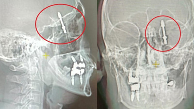 Beynine saplanan implant hayatını kararttı: 2 yıldır adalet bekliyor