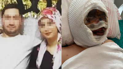 Gaziantep'te vahşet: Eski eşini kezzapla ağır yaraladı